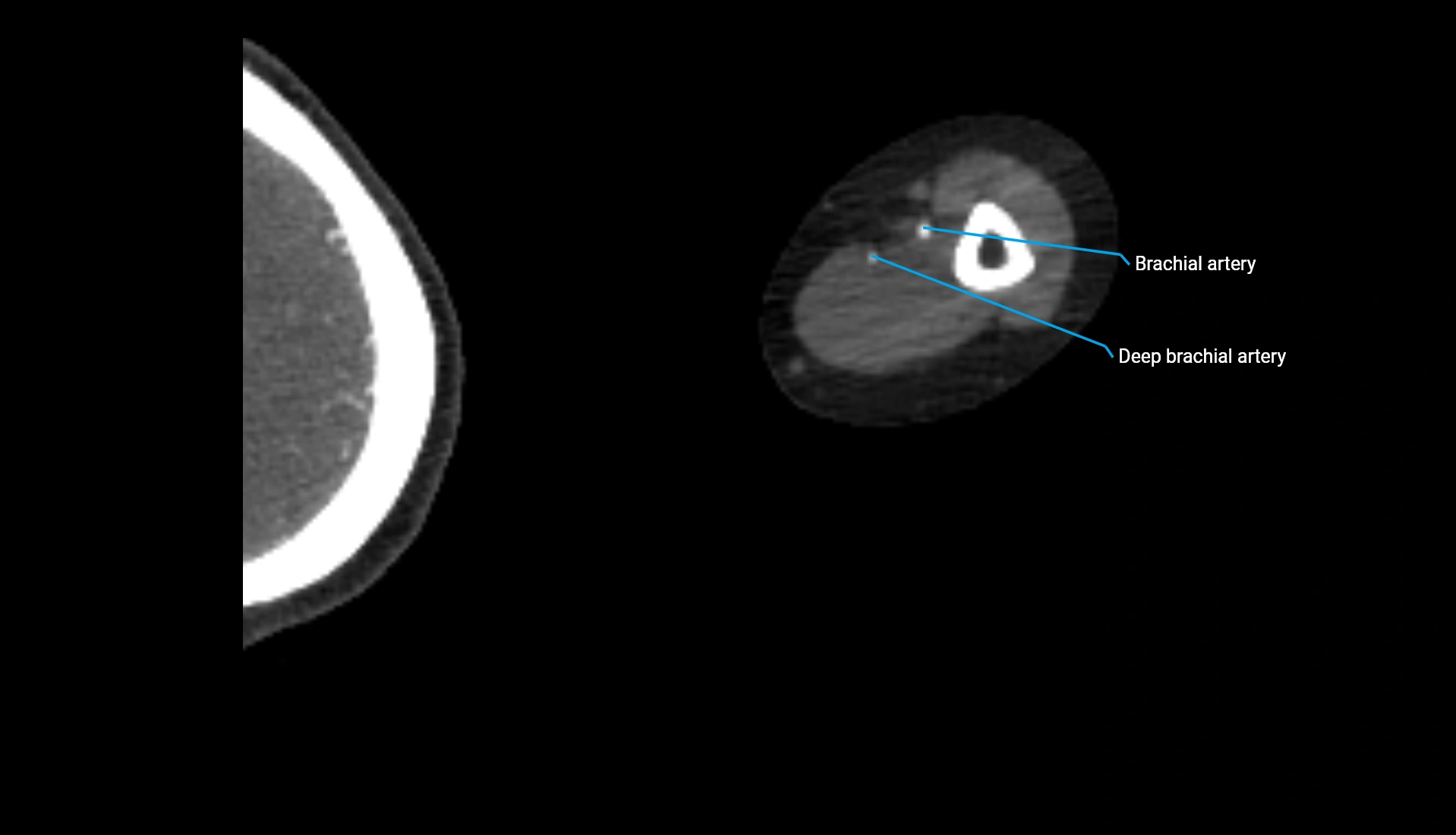 CTA upper limb axial cross sectional anatomy labelled image 220 (2).webp